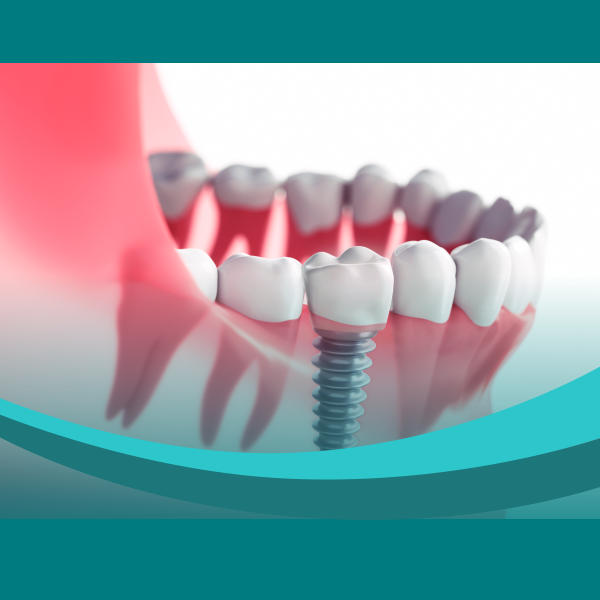 Implantes Dentários